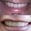 Veneers are ultra-thin sculpted pieces of tooth-shaped porcelain that fit over the front of your teeth. They are wonderful for fixing teeth that are significantly discolored, chipped, pitted, malformed, or crooked, or if you have unwanted spaces. 