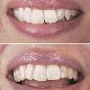 Composite bonding is the most versatile and effective way to aesthetically restore your smile. Composite materials are used to replace old unattractive fillings, change the color of your teeth, or reshape and recontour a less than ideal smile. 