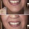  Kathy's smile was improved by bonding on the corner of one front tooth, and reshaping of some of the others. Notice how the overall appearance of the face changes in the lower pair of pictures.

