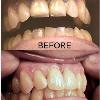 Crown restorations are similar to veneers, because they too are attached to individual teeth. Crowns  cover the tooth on all sides, helping to correct any problems that you might have with alignment. Crowns are used to repair teeth that have  root canals, or have severe erosion, decay, or fracture.